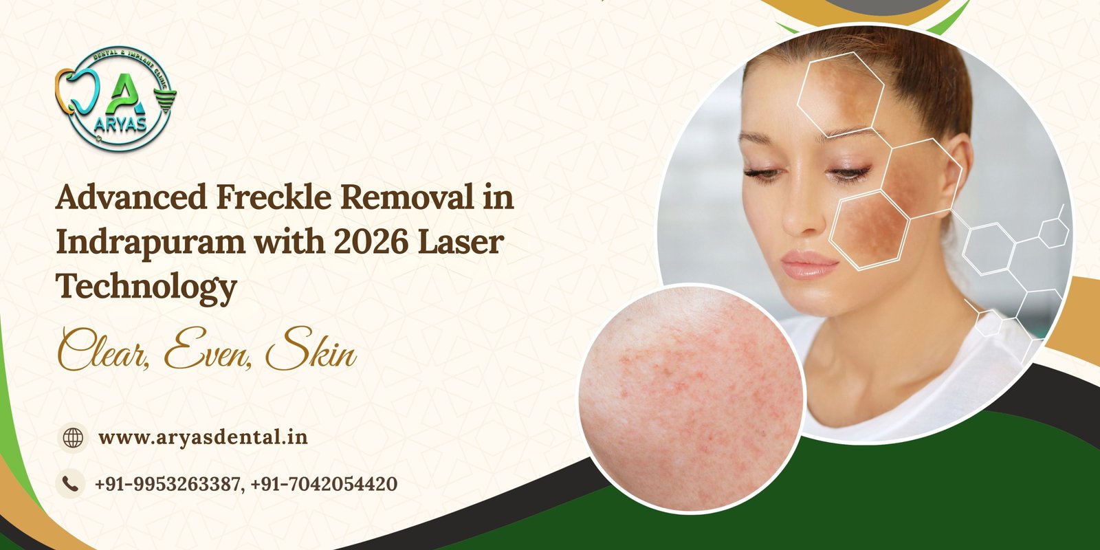 freckle-removal-Indirapuram-laser-treatment-clear-skin-Aryas-Dental-Ghaziabad-Indirapuram